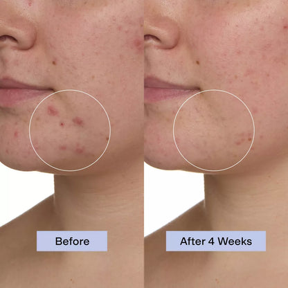 MINDBODYSKIN® Hormonal Acne Supplement